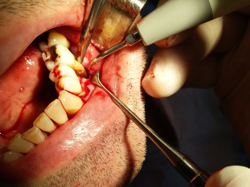 Ağız, Diş ve &Ccedil;ene Cerrahisi